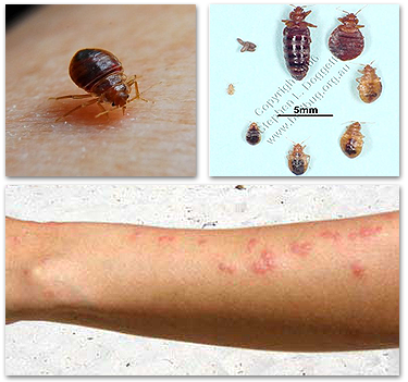Bed Bugs and Bites