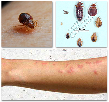 Bed Bugs and Bites Bed Bugs and Bites